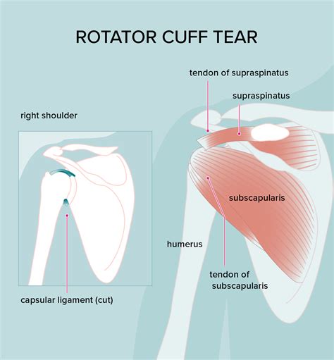 Rotator Cuff Injury: Treatments, Symptoms, and Diagnosis | Rotator cuff injury, Rotator cuff ...