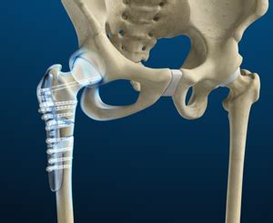 Open Reduction and Internal Fixation Hip