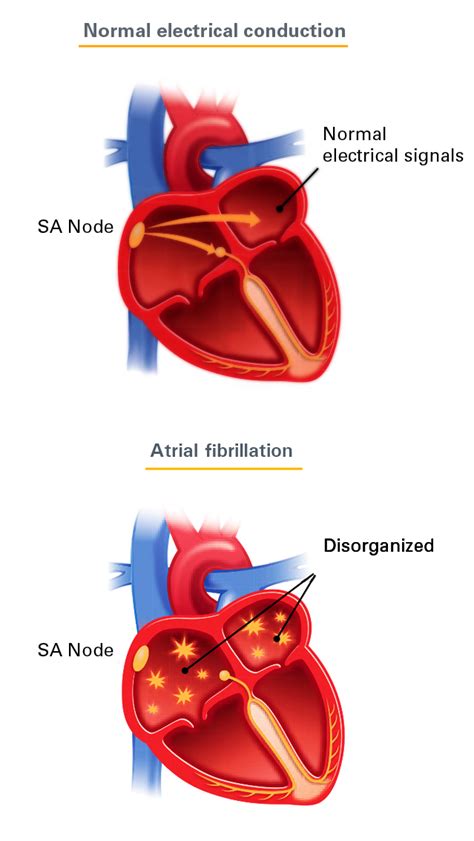 AF & Stroke Risk Atrial Fibrillation and Stroke Risk Reduction | WATCHMAN device