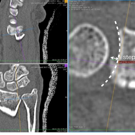 Volume-rendered 3D images of the sigmoid notch. The arrow indicates a... | Download Scientific ...