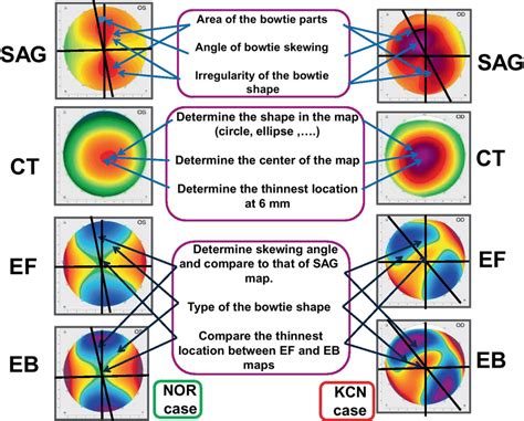 Example of the 4 corneal topographic maps, for normal (left) and KCN... | Download Scientific ...