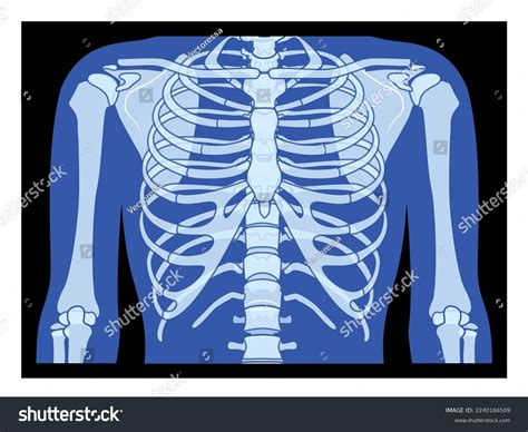 409 Broken Rib Cage Images, Stock Photos & Vectors | Shutterstock