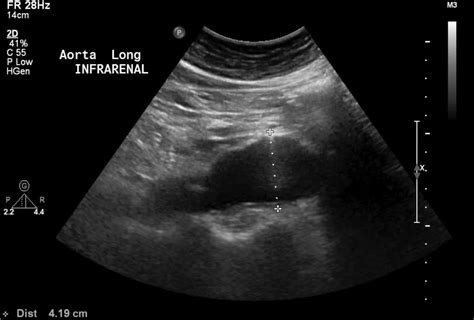 Ruptured Abdominal Aortic Aneurysm Ultrasound