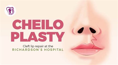 Cheiloplasty: Cleft Lip Repair At The Richardson’s Hospital – Richardson's Plastic Surgery Hospitals