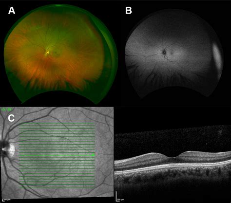 Achromatopsia: for professionals - Gene Vision