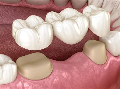 5 Dental Options for Replacing Missing Teeth - Dental Arts San Diego Blog