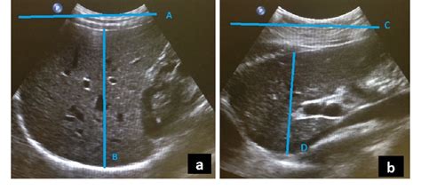 Methods of Determining the Size of the Adult Liver Using 2D Ultrasound ...