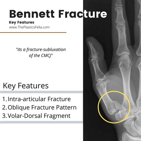 Bennett Fracture - X-Rays, Diagnosis, Treatment.