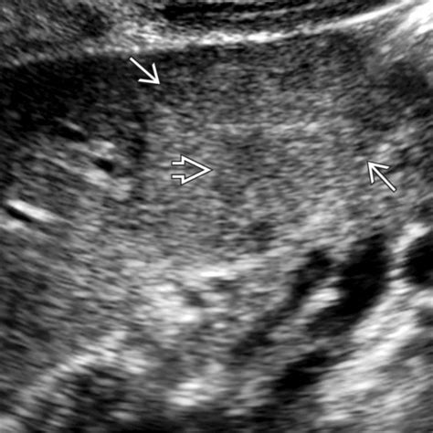 Focal Nodular Hyperplasia | Basicmedical Key