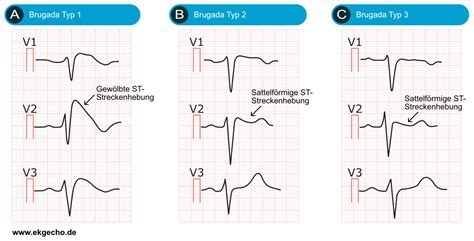 Brugada Ecg Findings