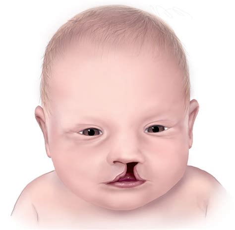 Cleft Palate & Cleft Lip - Causes, Symptoms, Repair, Surgery