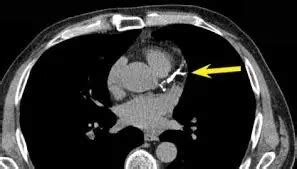 Coronary Calcium Score Benefits of Aged Garlic - Jeffrey Dach MD