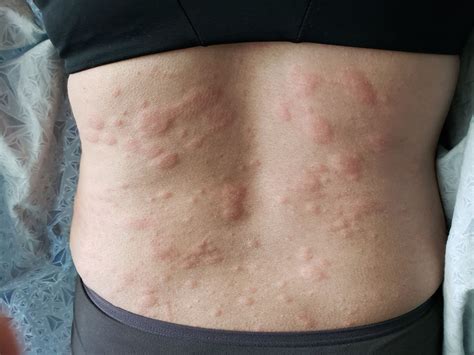 Hives & 4 Tips to Help