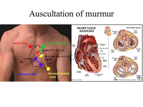 Aortic Stenosis Murmur