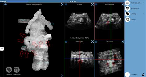 Comparison of Contrast-Enhanced Tomographic 3-D Ultrasound Against ...