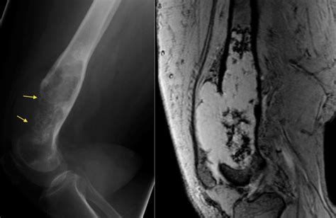 Chondrosarcoma - Radiology at St. Vincent's University Hospital