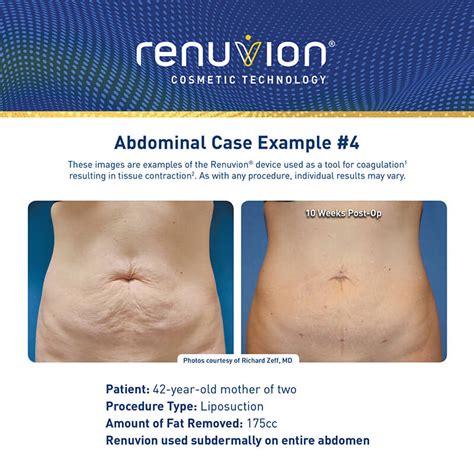 Renuvion: The Latest Tissue Contraction Technology - NuBody Concepts