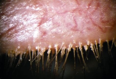 Blepharitis — Medlibes: Online Medical Library