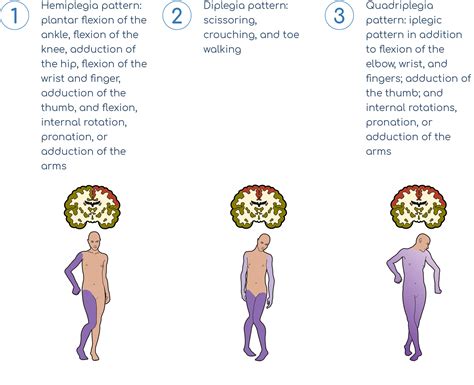 Types Of Cerebral Palsy Brain