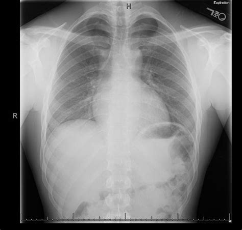 Hennepin Ultrasound | Spontaneous Pneumothorax