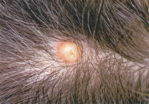 Boils on Scalp: Causes, Treatment, and Prevention for Boils on Your ...