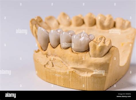 Dental prosthesis Stock Photo - Alamy