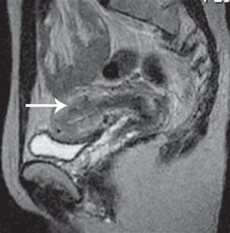 Adenomyosis. Sagittal MRI T2-weighted sequence acquired with a 0.2 T ...