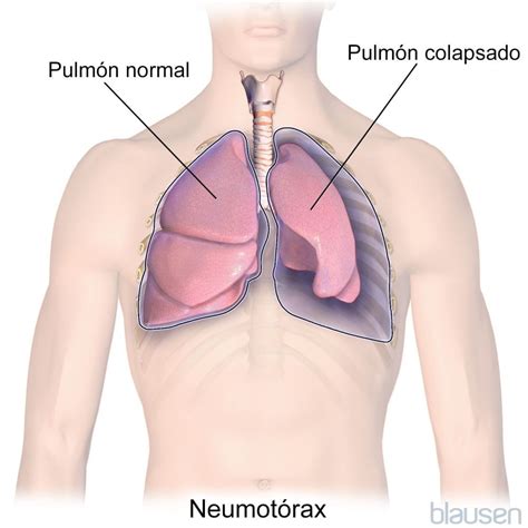 Neumotórax - Trastornos del pulmón y las vías respiratorias - Manual MSD versión para público ...