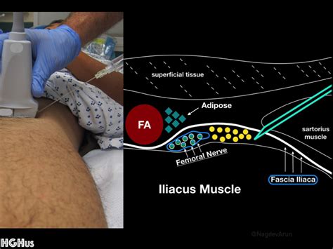 Infrainguinal Fascia Iliaca Plane Block ( AKA : Femoral Nerve Block) — Highland EM Ultrasound ...