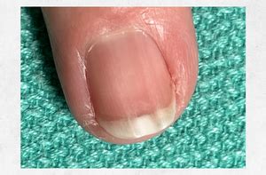 What causes these VERTICAL ridges in my fingernails? – Appalachian, nail ridges treatment