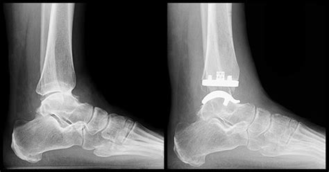 Ankle Replacement Surgery: How It Works, Recovery Time | HSS