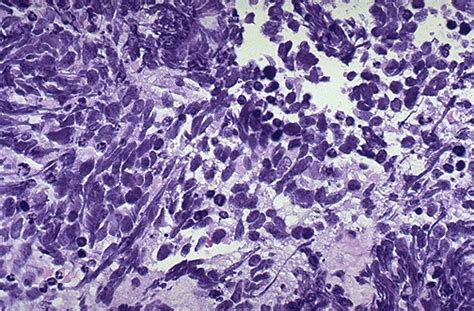 Pulmonary Pathology