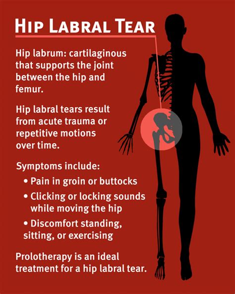 Hip Labral Tear Treatment