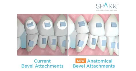 Spark Aligners Does It Again With Market Leading Innovation And New FDA Approval To Give Doctors ...