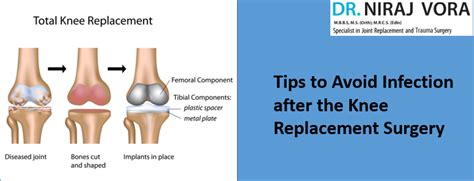 Tips to Avoid Infection after the Knee Replacement Surgery