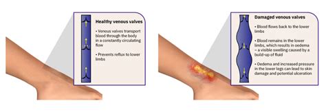 Treatment venous leg ulcers | Symptoms, causes and cleaning | Absorbest