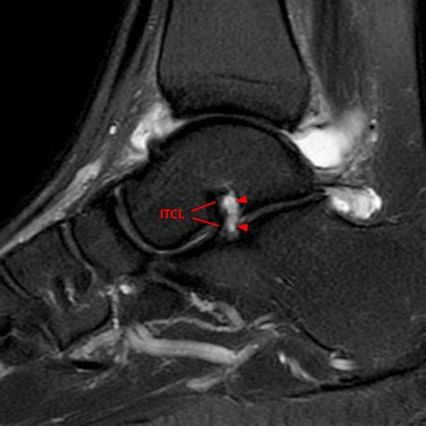 Sinus Tarsi Syndrome | Radsource