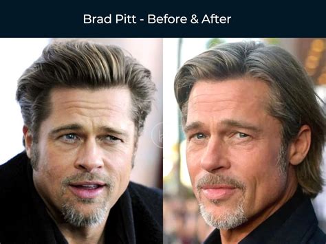 6+ Brad Pitt Hair Transplant - VilmaLenard