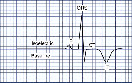 Interpretation of Electrocardiogram Tracings | Thoracic Key