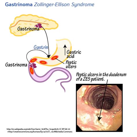 Zollinger-Ellison Syndrome: Video, Anatomy Definition, 45% OFF