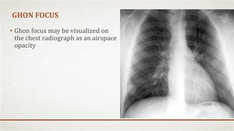 Radiographic manifestations of pulmonary tuberculosis | PPT