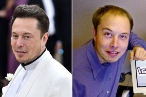 Elon Musk Hair Transplant - Before and After - HowChimp