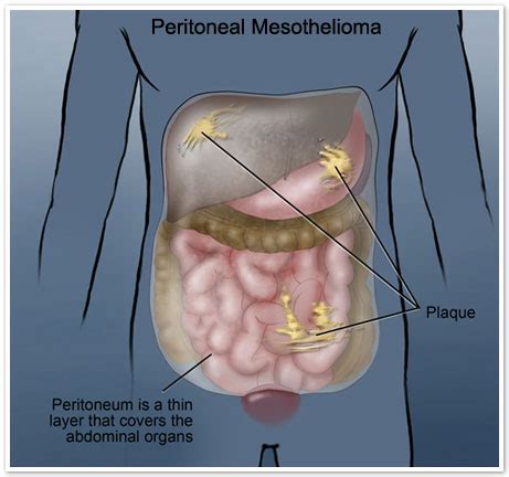 Peritoneal Mesothelioma | Treatment, Prognosis & Diagnosis