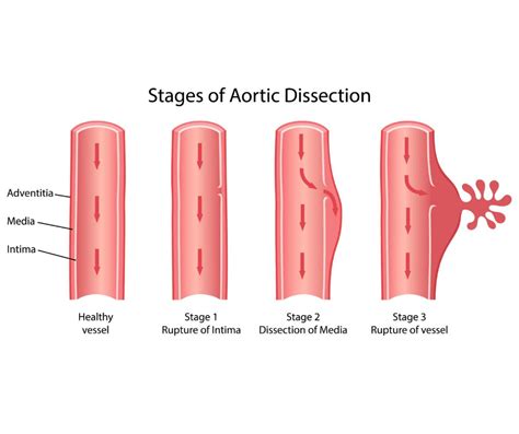 Aortic Dissection | My Vascular Health