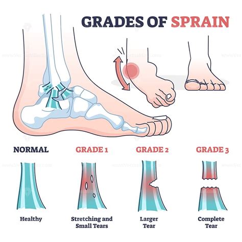 Grades of sprain as ankle or foot medical injury levels outline diagram ...