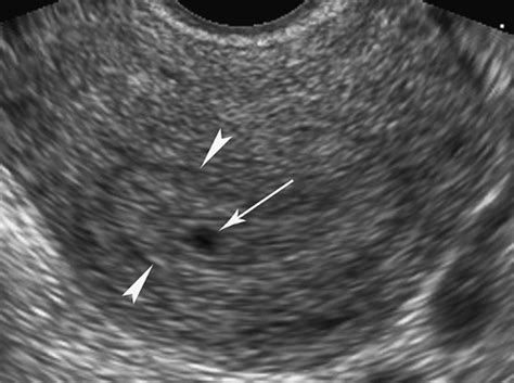 Obstetric Ultrasound | Radiology Key