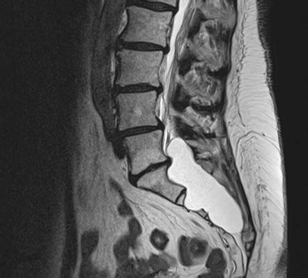 Tarlov Cyst Mri