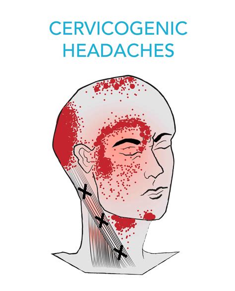 Complete Car Physio - Cervicogenic Headache