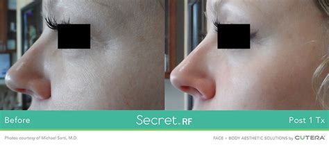 Cutera Secret RF Microneedling Treatment | Midtown Med Spa Services | Midtown Med Spa Toronto