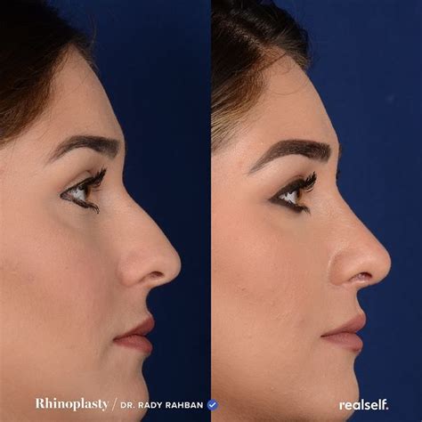 How Much Does Rhinoplasty Cost? Nose Job Prices in 2024 | RealSelf | Nose job, Rhinoplasty ...